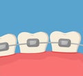 The concept of teeth alignment with braces. Simple teeth in a row. Orthodontic treatment. Vector cartoon illustration Royalty Free Stock Photo