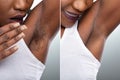 Before And After Concept Of Underarm Hair Removal Royalty Free Stock Photo