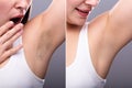 Before And After Concept Of Underarm Hair Removal