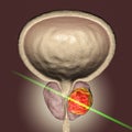 Conceptual image for prostate cancer treatment