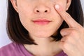 Close-up of woman pointing a problem on her face with variety problems on her skin such as Acne, Pimple, Pores and Melasma etc. Royalty Free Stock Photo