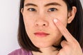 Close-up of woman pointing a problem on her face with variety problems on her skin such as Acne, Pimple, Pores and Melasma etc. Royalty Free Stock Photo