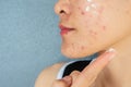 Cropped shot of woman half face with acne inflammation Papule and Pustule on her face and she applying acne cream on her face fo