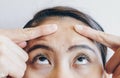 Close up of woman pointing on her forehead with redness acne problems on her skin. Royalty Free Stock Photo