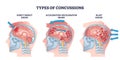 Concussion and head trauma or injury types from medical view outline diagram