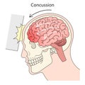 Concussion structure diagram medical science