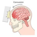 Concussion structure diagram medical science
