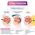 Concussion vector illustration. Labeled educational post head trauma scheme Royalty Free Stock Photo