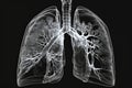 A condition where cancerous cells develop and form a tumor in the lungs, commonly known as lung cancer created with generative ai