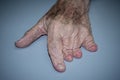 Congenital abnormality in left hand