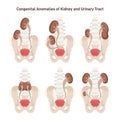 Congenital anomaly of kidneys set. Urinary system organ inborn