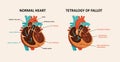 Congenital disease of the heart
