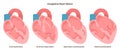 Congenital diseases of the heart set. Ventricular and atrial septal defect,