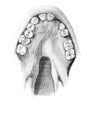 Congenital fissure of the soft palate in the old book D`Anatomie Chirurgicale, by B. Anger, 1869, Paris