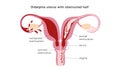 Congenital malformation of uterus isolating part of organ and causing retrograde menstruation as possible reason of