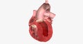Congestive Heart Failure Left Sided Diastolic