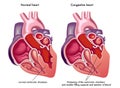 Congestive heart