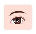 Conjunctival nevus vector illustration