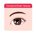 Conjunctival nevus vector illustration