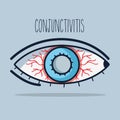 Conjunctivitis allergic inflammation of vision eye