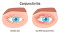 Conjunctivitis. Diseases of the human eye. Viral, bacterial, allergic