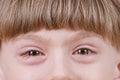 Conjunctivitis - ill allergic eyes