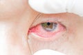 Conjunctivitis and inflammation in the eyes