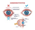 Conjunctivitis or pink eye medical condition explanation outline diagram