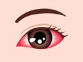 Conjunctivitis pink eye vector illustration