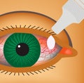 Conjunctivitis. Redness and inflammation of the eye. Vessels. Eye drops. Infographics. Vector illustration. Royalty Free Stock Photo