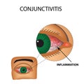 Conjunctivitis.