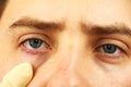 Conjunctivitis, tired eyes, red eyes, eye disease