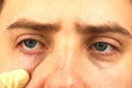 Conjunctivitis, tired eyes, red eyes, eye disease