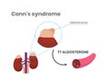 Conn`s syndrome pathophysiology. Primary aldosteronism scientific medical illustration Royalty Free Stock Photo