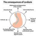 The consequences of lordosis. Spinal curvature, kyphosis, lordosis, scoliosis, arthrosis. Improper posture and stoop