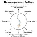 The consequences of scoliosis. Spinal curvature, kyphosis, lordosis of the neck, scoliosis, arthrosis. Improper posture