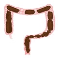 Constipation. Feces in colon. Infographics. Vector illustration on isolated background.