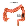 Constipation. large intestine