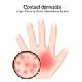 Contact dermatitis. Atopic eczema