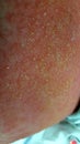 Contact dermatitis with secondary streptococcal cellulitis and lymphangitis