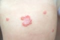 Contagious bacterial dermatologic infection impetigo on a child skin without pharmacologic treatment.  Macro shot Royalty Free Stock Photo