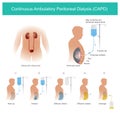 Continuous Ambulatory Peritoneal Dialysis CAPD Royalty Free Stock Photo