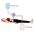 Continuous Ambulatory Peritoneal Dialysis (CAPD)