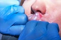 Contour plastic: Dermatologist performs lips massage after the c