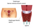 Contraceptive method- Diaphragm