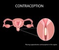 Contraceptives suppositories. Infographics. Vector illustration on a black background. Royalty Free Stock Photo