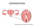 Contraceptives suppositories. Infographics. Vector illustration on isolated background