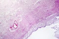 Contracted kidney, light micrograph Royalty Free Stock Photo