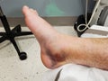 Contusion and blister on exposed patient leg in ER