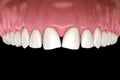 Convergent diastema of central incisors teeth. Dental disfunction 3D illustration concept